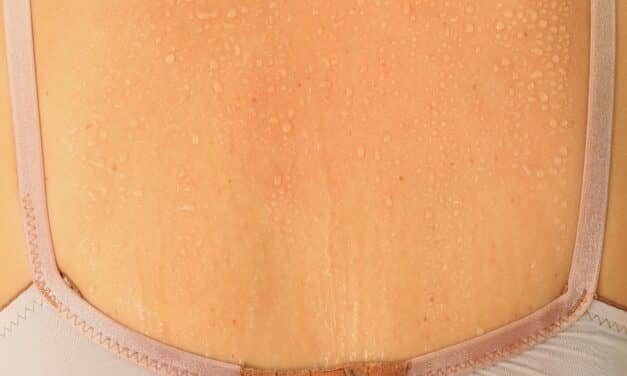 Night Sweat Analysis Reveals Sleep Apnea Severity
