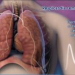 Allegheny Health Network Implants Central Sleep Apnea Patient with Neurostimulator