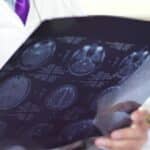 Sleep Apnea and Stroke Can Cause One Another