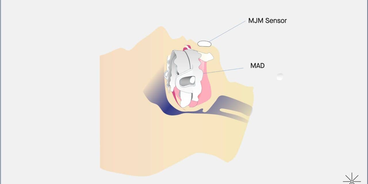 sunrise titrate oral appliance