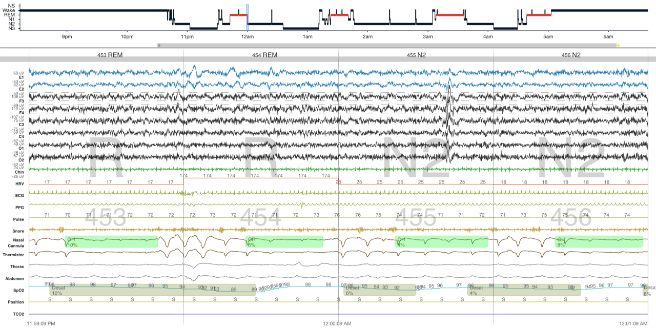 How Software Can Simplify Hypopnea Scoring for Varied Payors