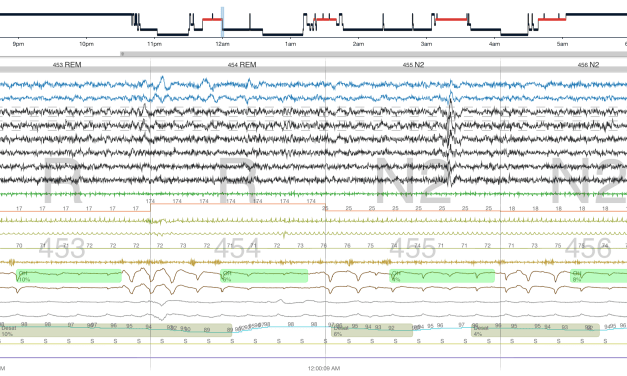 How Software Can Simplify Hypopnea Scoring for Varied Payors