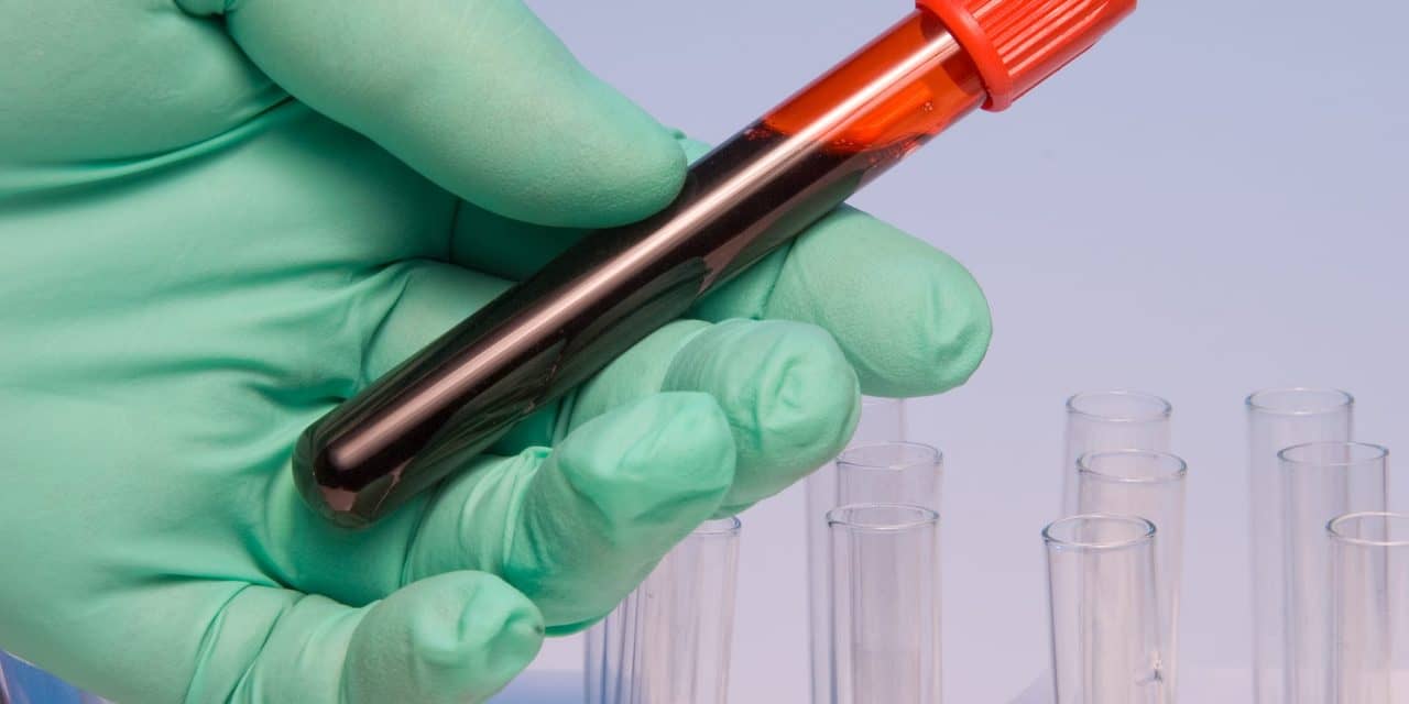 Blood Sample Timing Affects Dementia Diagnostic Results