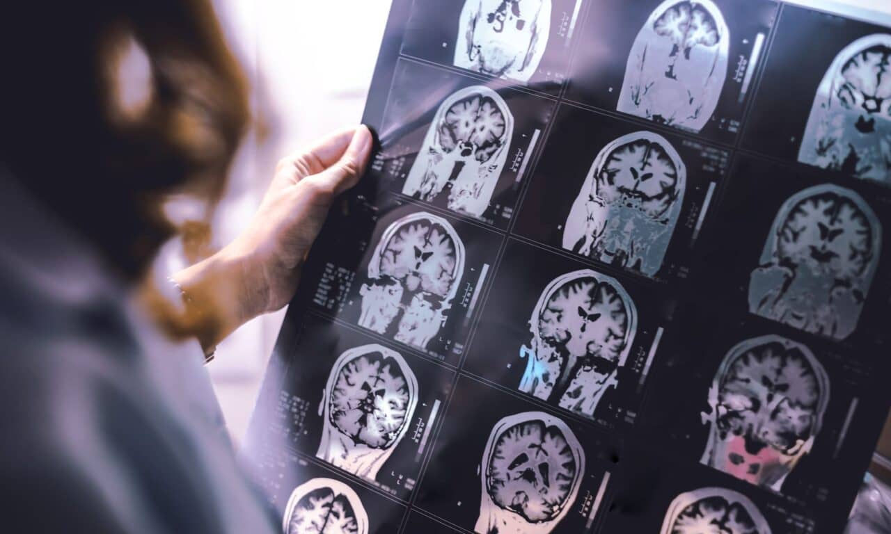 People with Sleep Apnea Have Larger Hippocampus After 10 Years, Study Finds