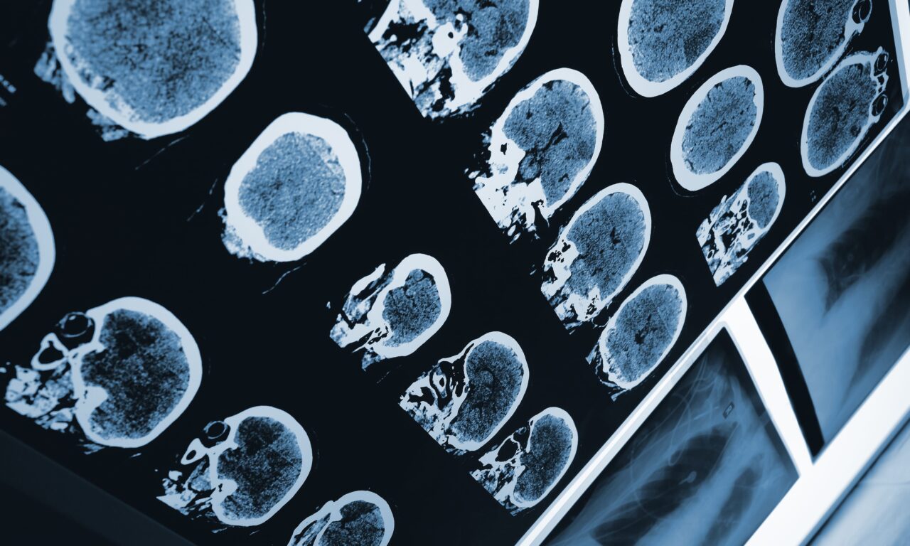 Sleep Disorder Patients’ Brain Scans Could Forecast Future Parkinson’s Development