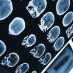 Sleep Disorder Patients’ Brain Scans Could Forecast Future Parkinson’s Development