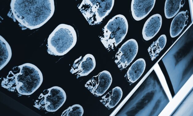 Sleep Disorder Patients’ Brain Scans Could Forecast Future Parkinson’s Development
