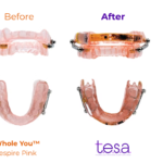 New Smart Sensors Embed into Oral Appliances for Therapy Monitoring