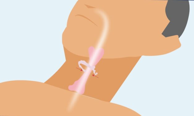 Hyoid Suspension for OSA ‘Effective and Non-Investigational’