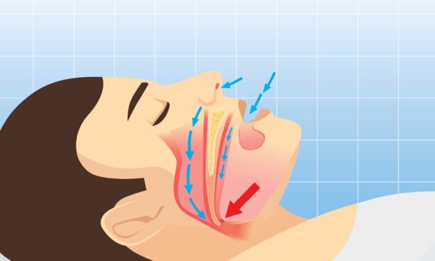 Pivotal Phase 3 Topline Results for Neuromuscular-Targeting OSA Drug Candidate