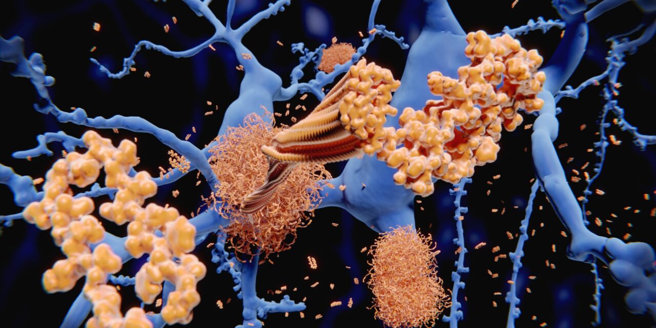 alzheimers disease beta amyloid sleep