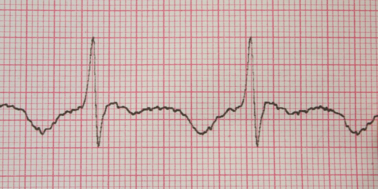 AI Algorithm Uses ECG to Identify OSA, Finds Stronger Signal in Women