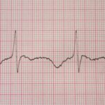 AI Algorithm Uses ECG to Identify OSA, Finds Stronger Signal in Women