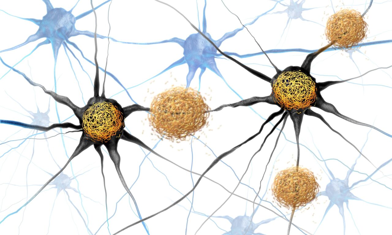 Study: Specific Sleeping Pill Blocks Tau-Mediated Neurodegeneration in Mice