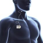 FDA Approves LivaNova’s aura6000 Neurostimulator for OSA