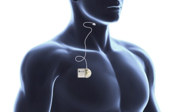 12-Month Results from LivaNova’s OSPREY Clinical Study Published